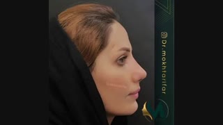 یک ماه پس از جراحی زیبایی بینی در مراجعه کننده عزیزمون از شهر دورود