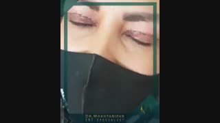 فیلم جراحی بلفاروپلاستی جهت رفع افتادگی پلک، با بی حسی موضعی در مطب