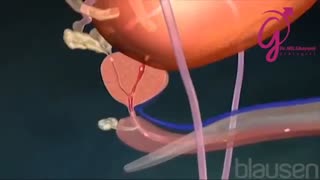 فیلم عمل وازکتومی