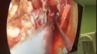 جراحی تومور هیپوفیز از راه بینی