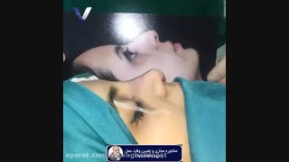 نمونه جراحی بینی بلافاصله بعد از عمل