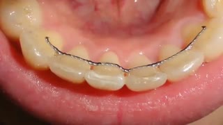 تا چه مدت باید نگهدارنده ها (ثابت یا متحرک) استفاده بشوند؟ | دکتر سعید قریشی
