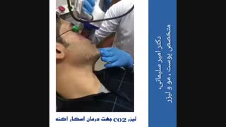 فیلم رفع جای جوش با لیزر co2