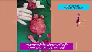 فیلم جراحی خارج کردن میوم های بزرگ از رحم