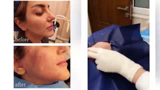 فیلم واقعی لیفت نخ با هدف جوانسازی