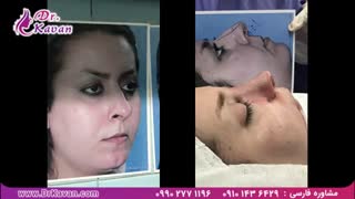 عمل زیبایی بینی