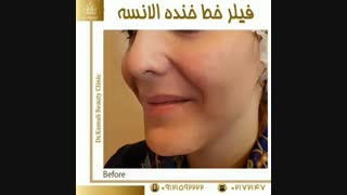 فیلم تزریق فیلر خط خنده الانسه