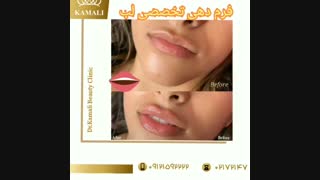 فیلم واقعی فرم دهی لب