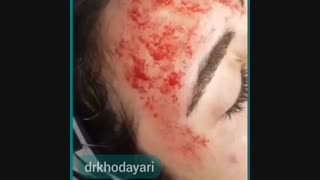فیلم میکرونیدلینگ صورت در کلینیک دکتر خدایاری