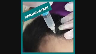 فیلم مزوتراپی مو سر دکتر مصطفی خدایاری