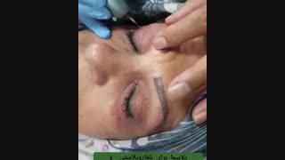 فیلم پلاسما برای بلفاروپلاستی و چین و چروک پلک فوقانی و تحتانی
