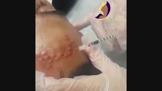 انجام مزوتراپی برای لک های صورت (ملاسما)