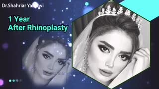 یکسال بعد از جراحی بینی | دکتر یحیوی
