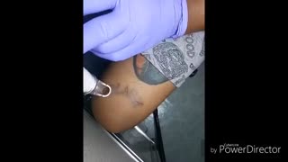 لیزر Neatsellحذف خال وتاتو