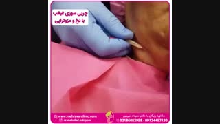 چربی سوزی غبغب با نخ و مزوتراپی