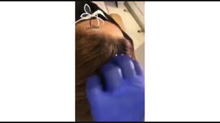 فیلم جالب از مزوتراپی موی سر