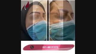 فیلم واقعی کاشت ابرو