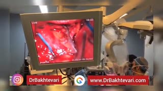 آنوریسم مغزی