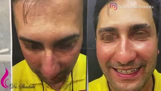 فیلم جراحی بینی گوشتی با پوستی بسیار ضخیم