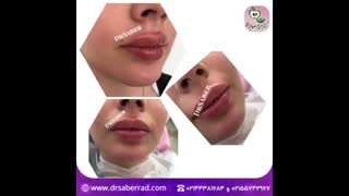 تزریق فیلر لب