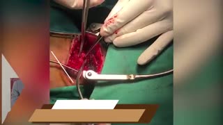 فیلم واقعی جراحى تومور متاستاتیک مخچه در خانم 60 ساله با سابقه سرطان پیشرفته