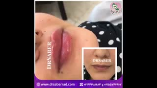 تزریق کمتر از یک سی سی فیلر به لب