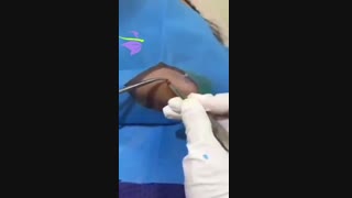 فیلم خال برداری با لیزر