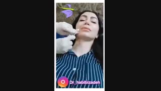 فیلم بوتاکس خط خنده