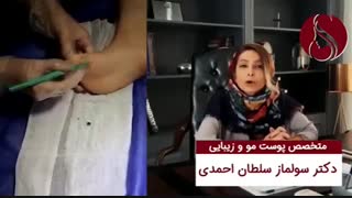 فیلم در مورد عامل  ایجاد زگیل پوستی