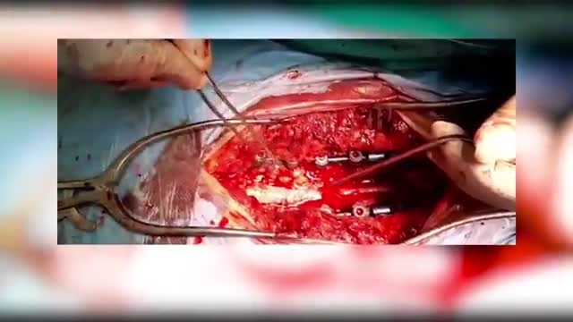 فیلم جراحی تنگی کانال نخاعی