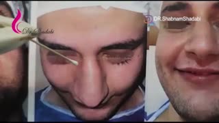 بلافاصله بعد از عمل بینی گوشتی با پوست ضخیم