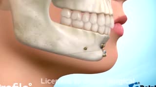 توضیحات دکتر آرمان انقطاع درباره روش های زیباسازی چانه