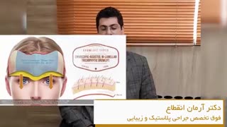 روش های لیفت پیشانی و ابروها