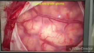 فیلم جراحی تومور مغزی