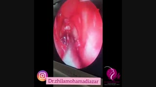 جراحی تومور مغزی از بینی