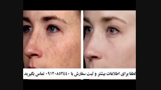 کیفیت کرم ضد لک صمیم 09120852440 جراحی لثه