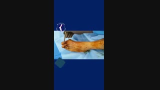 فیلم جراحی اصلاح کجی شصت پا