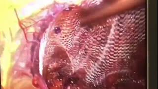 مش های جراحی در جراحی لاپاروسکوپیک هرنی کشاله ران
