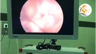 هیسترسکوپی خارج کردن فیبروم