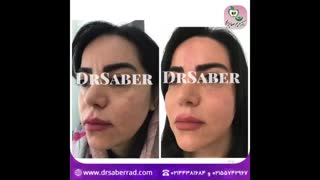 تزریق فیلر الانسه به گونه تزریق