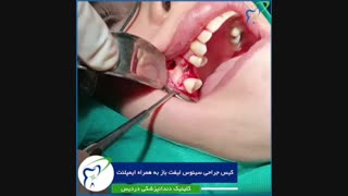 جراحی سینوس لیفت باز به همراه ایمپلنت