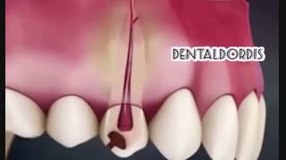 جرم چه بلایی سر دندان می آورد ؟؟