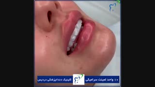10 واحد لامینیت سرامیکی زیبا و طبیعی