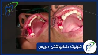 جراحی ایمپلنت دندان