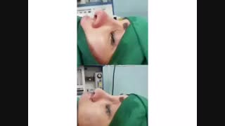 فیلم واقعی جراحی ترمیمی بینی + سانترال لب - قبل و بعد از عمل