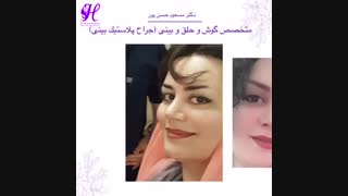 نتیجه جراحی زیبایی بینی 9 ماه بعد از جراحی