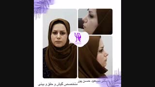 نمونه جراحی بینی دکتر حسن پور
