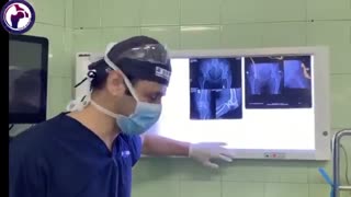 روماتیسم مفصلی