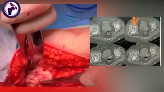 عوارض تاخیر در جراحی تعویض مفصل