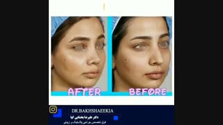 نمونه کار جراحی بینی دخترانه